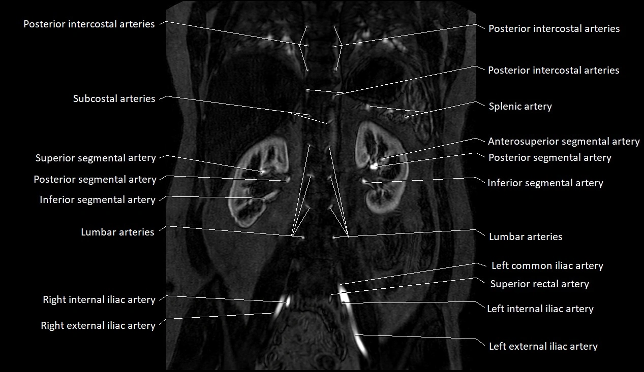MRA Abdomen coronal anatomy image 31.webp